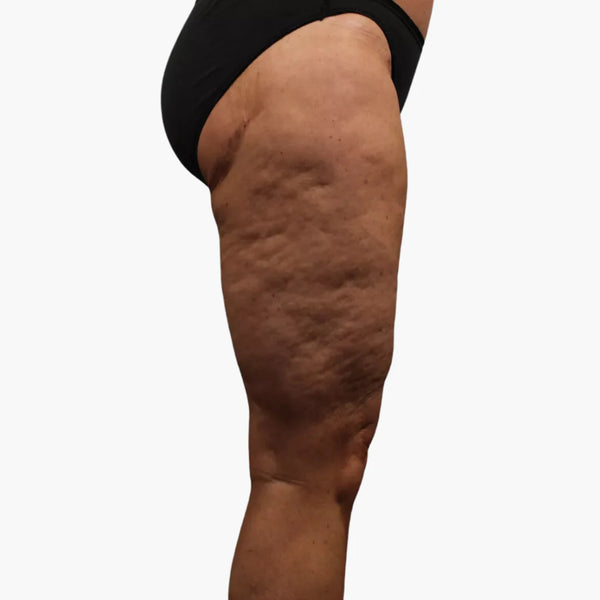 Många upplever en jämnare hudstruktur och minskad synlighet av celluliter, tillsammans med en lättare känsla i lymfflödet. – före