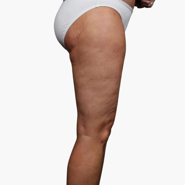 Många upplever en jämnare hudstruktur och minskad synlighet av celluliter, tillsammans med en lättare känsla i lymfflödet. – efter