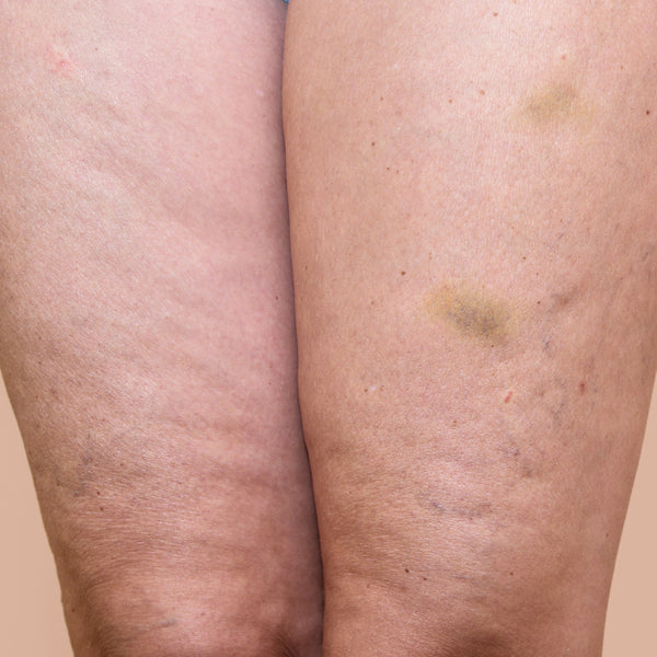 Hudens utseende upplevs förbättrat och celluliter mindre synliga med regelbunden användning. – före